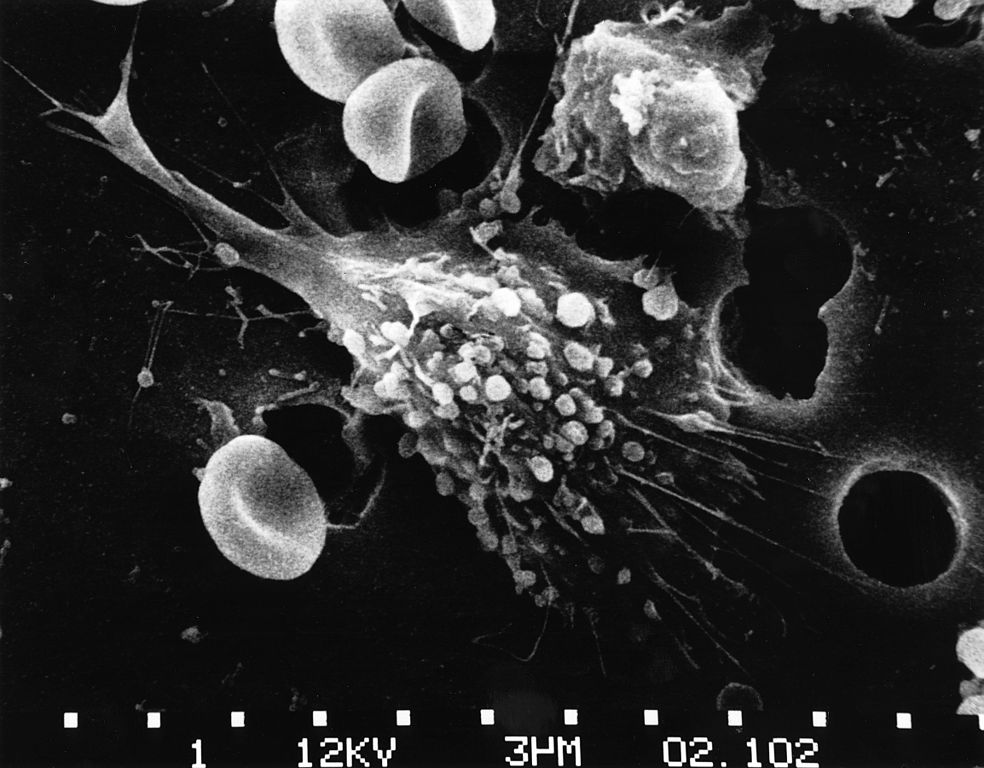 خلية سرطانية اثناء الموت
